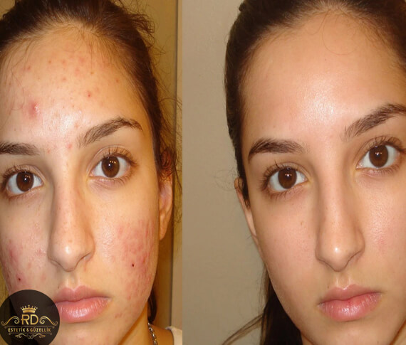 Akne Leke Tedavisi